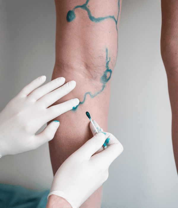 cirugia-vascular-precio.png